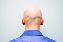 Calvicie, también conocida como alopecia.